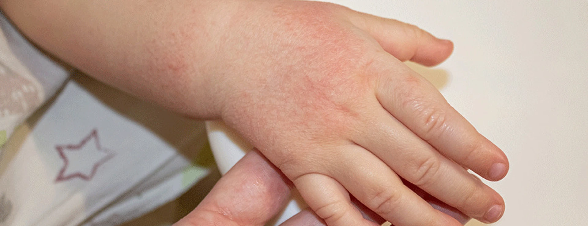Hand mit Neurodermitis