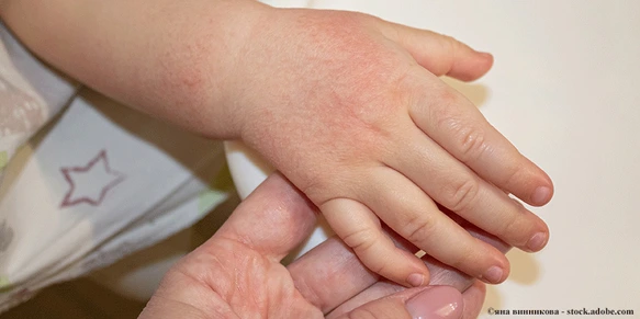 Rote Flecken auf der Haut der Hände eines Kindes. Kinderallergie. Trockenheit und Reizung der Haut