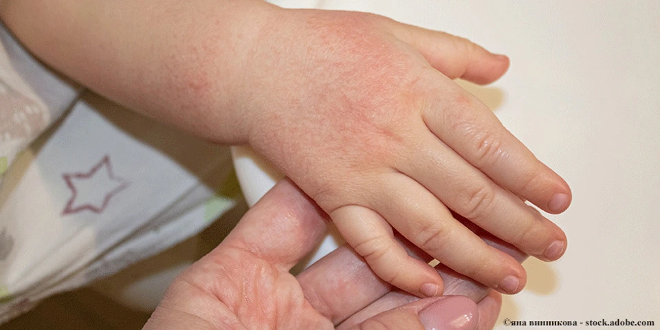 Neurodermitis beim Kleinkind