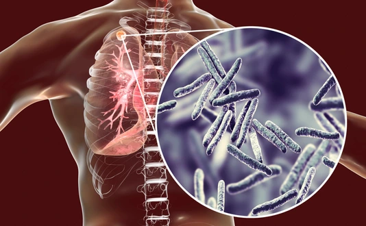 Secondary tuberculosis in lungs and close-up view of Mycobacterium tuberculosis bacteria