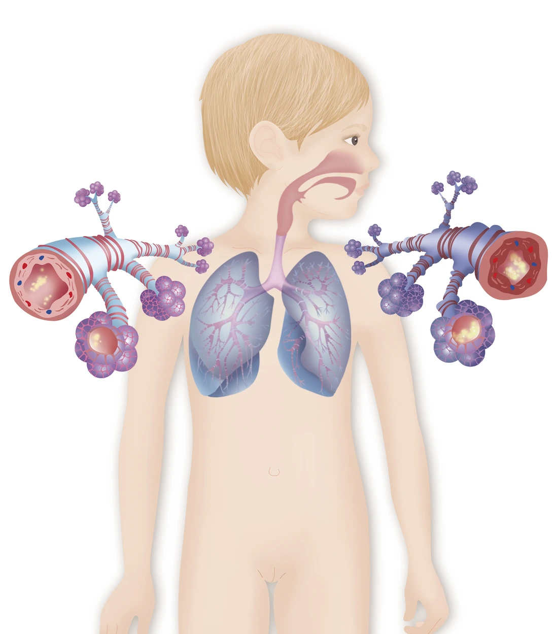 ASTHME DESSIN