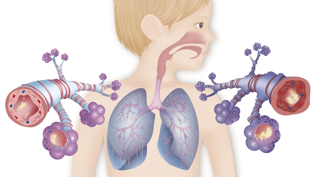 Représentation d'une bronche saine (à gauche) et d'une bronche en pleine crise d'asthme (à droite).