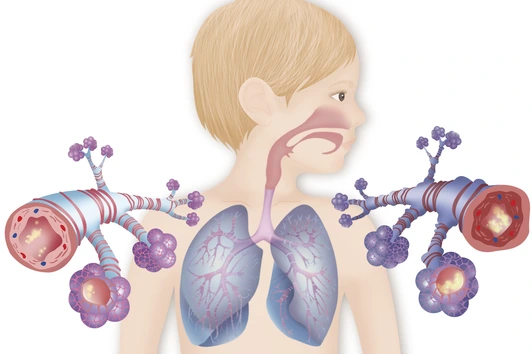 ASTHME DESSIN