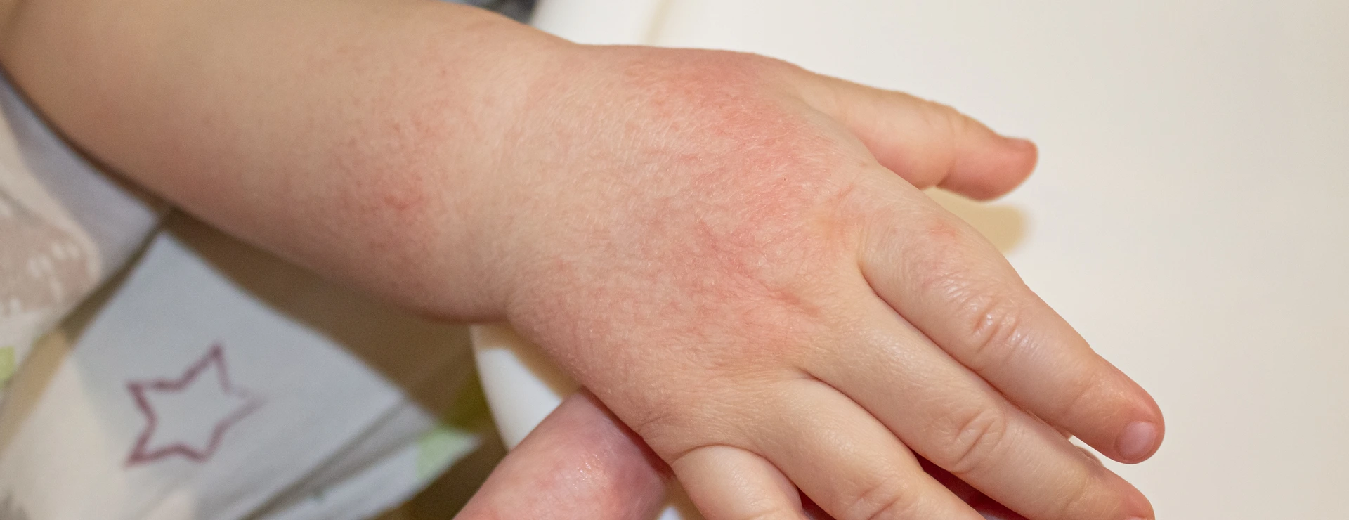 Atopische Dermatitis - Kinderhand
