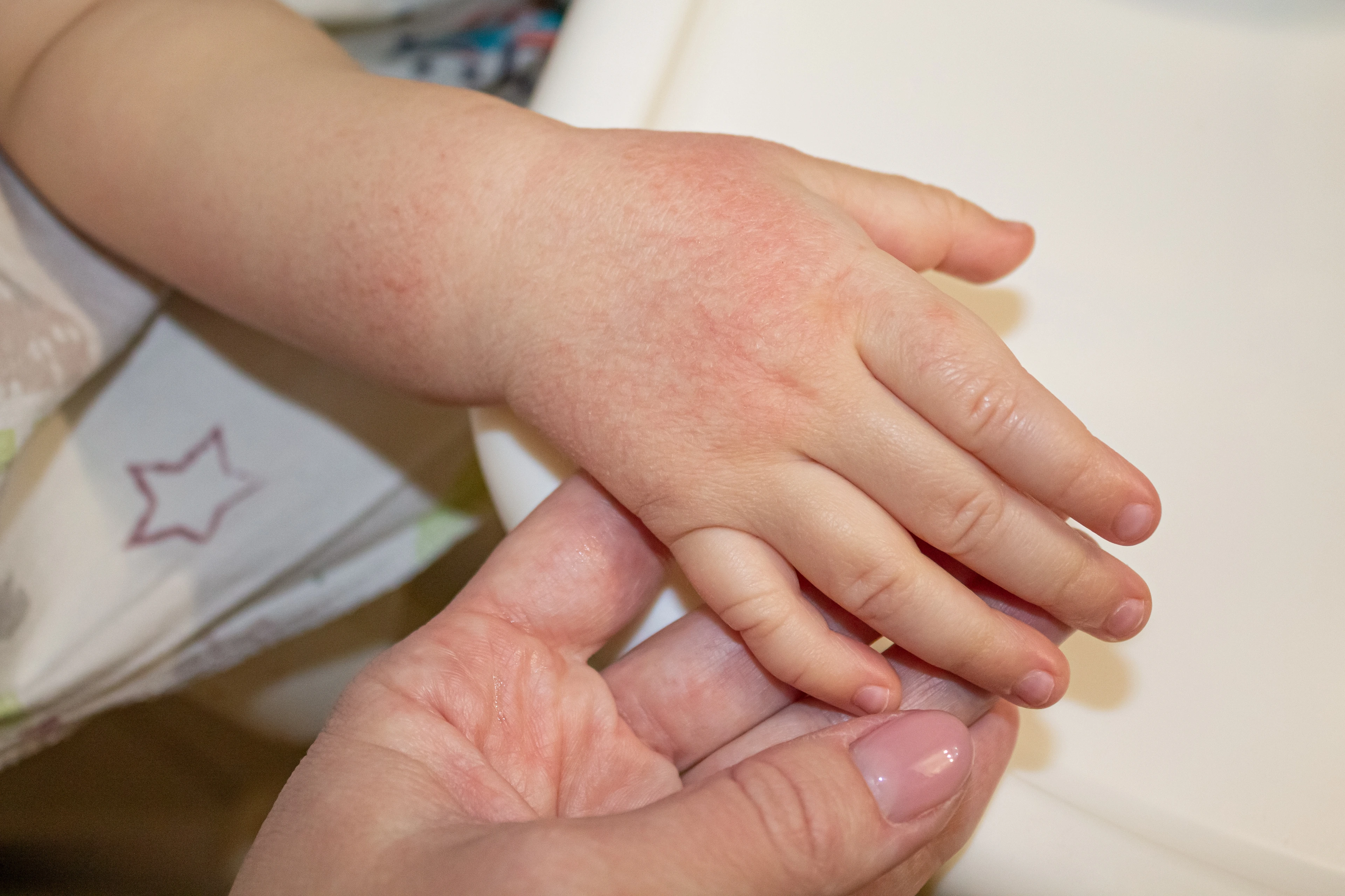 Red spots on the skin of the hands of a child. children's allergy. Dryness and irritation of the skin