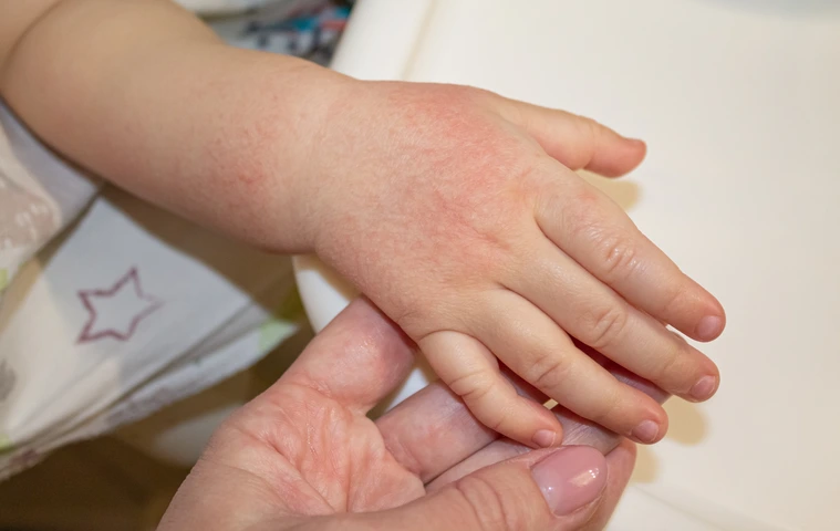 Red spots on the skin of the hands of a child. children's allergy. Dryness and irritation of the skin