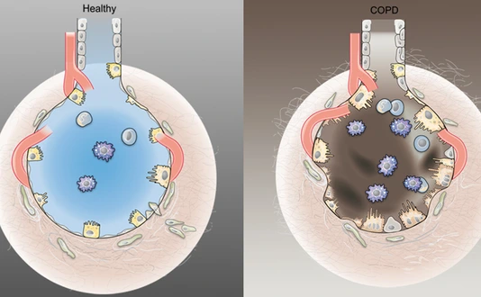 grafik_alveolen_healthy_copd_angelika_kramer