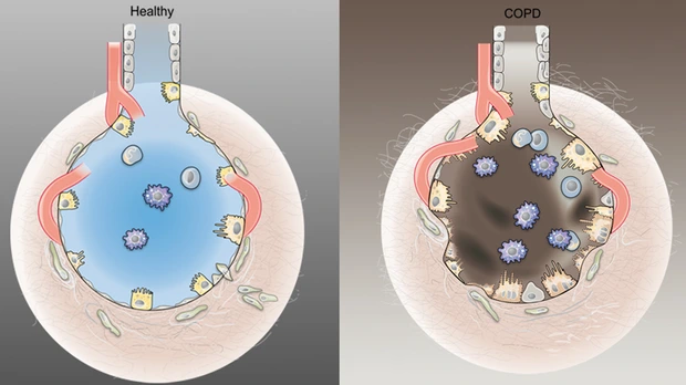 grafik_alveolen_healthy_copd_angelika_kramer