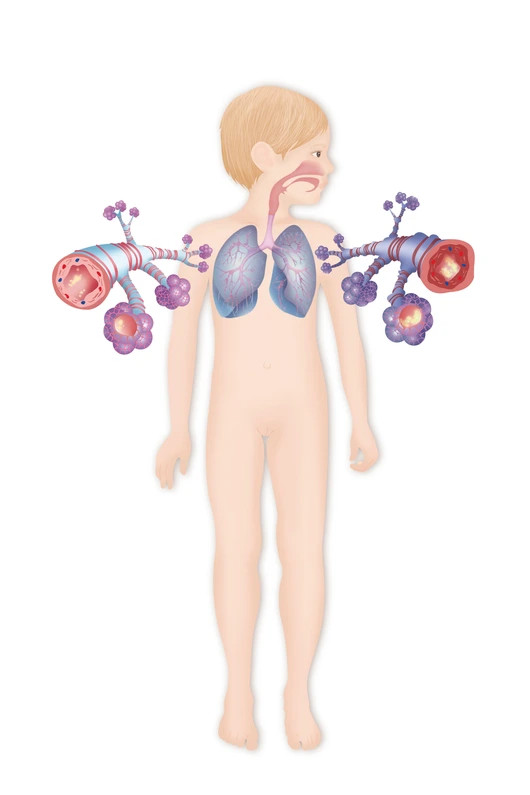ASTHME DESSIN