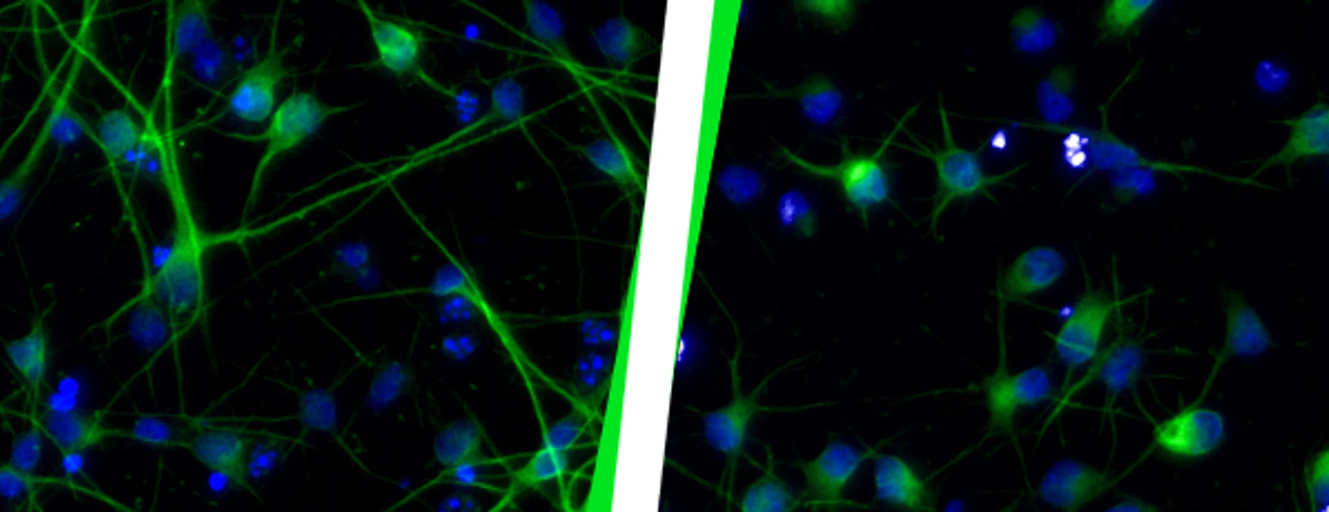 Healthy neurons (left) compared to neurons after HERV-K(HML-2) activation (right).
