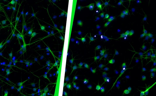 Healthy neurons (left) compared to neurons after HERV-K(HML-2) activation (right).