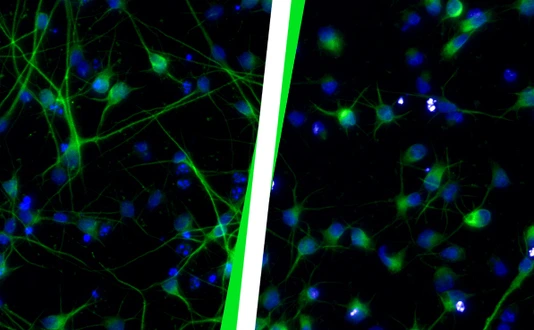 Healthy neurons (left) compared to neurons after HERV-K(HML-2) activation (right).