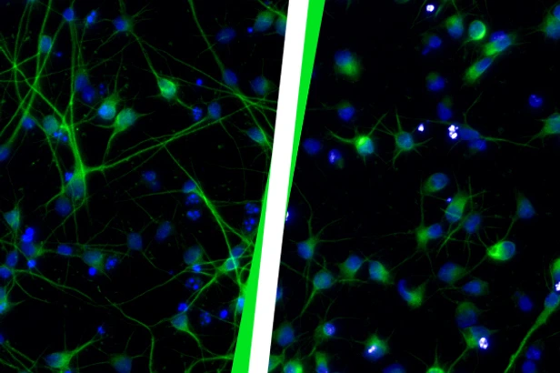 Healthy neurons (left) compared to neurons after HERV-K(HML-2) activation (right).