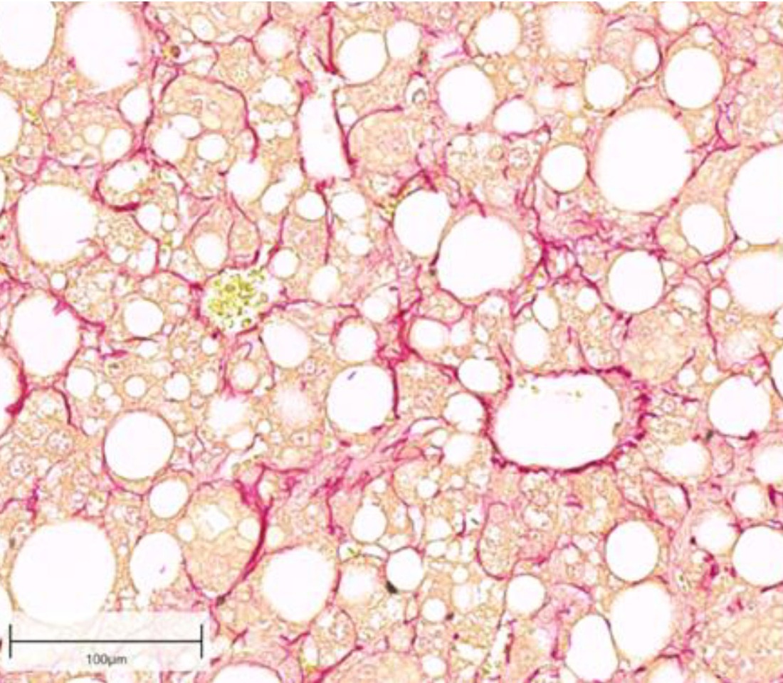 Fibrotic liver section with marked collagen fibers in red