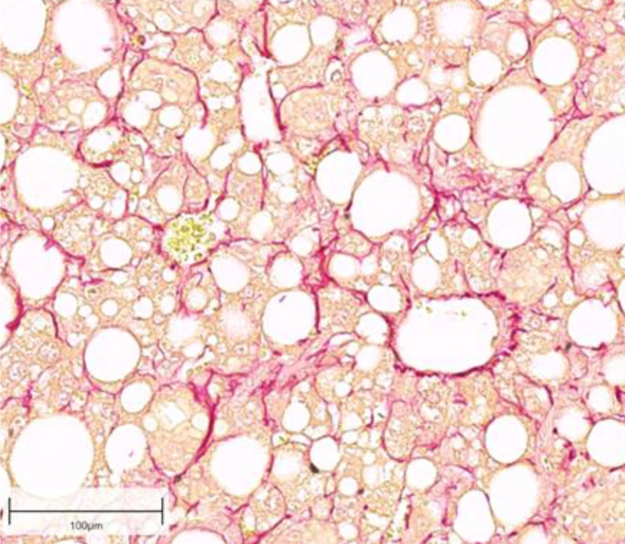 Fibrotic liver section with marked collagen fibers in red