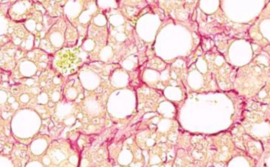 Fibrotic liver section with marked collagen fibers in red