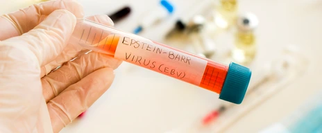 Mononucleosis and Epstein-barr virus blood test sample in lab on the white background, laboratory table