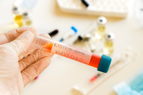 Mononucleosis and Epstein-barr virus blood test sample in lab on the white background, laboratory table
