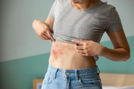 Urtikaria Nesselsucht Allergie