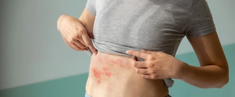Urtikaria Nesselsucht Allergie