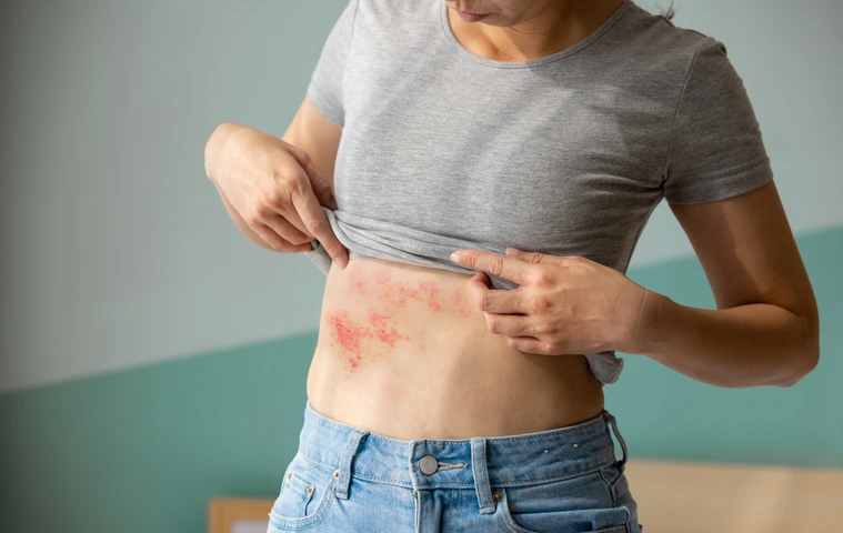 Urtikaria Nesselsucht Allergie