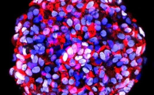 Trigger in MODY3 diabetes: Insulin hypersecretion precedes pancreatic β cell failure