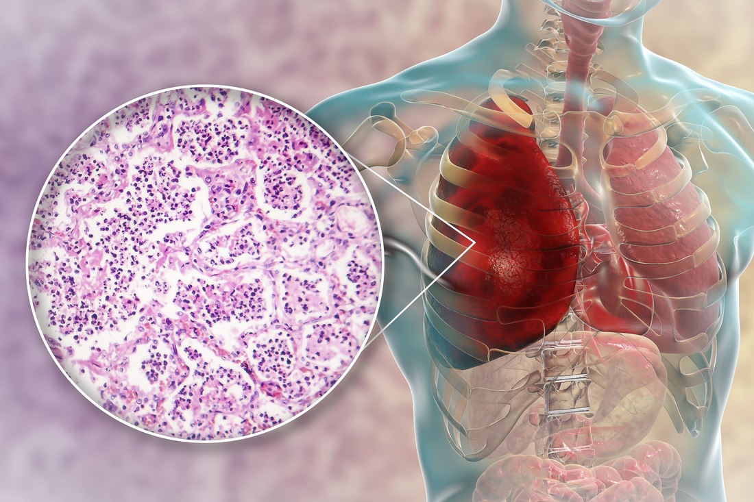 Lobar pneumonia, red hepatic phase