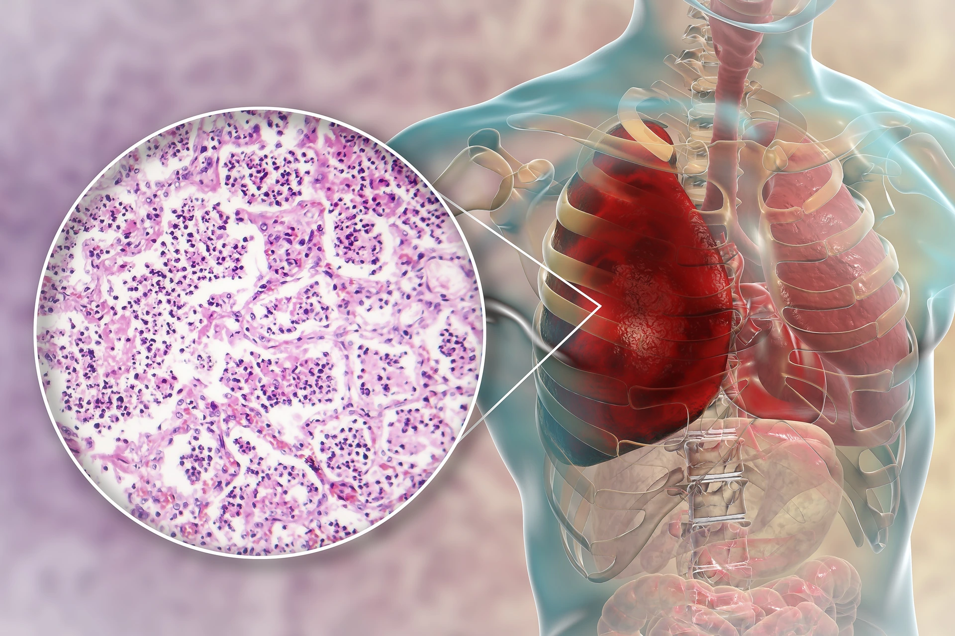 Lobar pneumonia, red hepatic phase