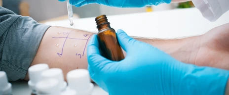 Hauttest zur Diagnose einer Allergie