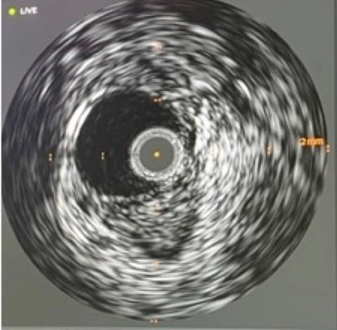 Intravaskulärer Ultraschall