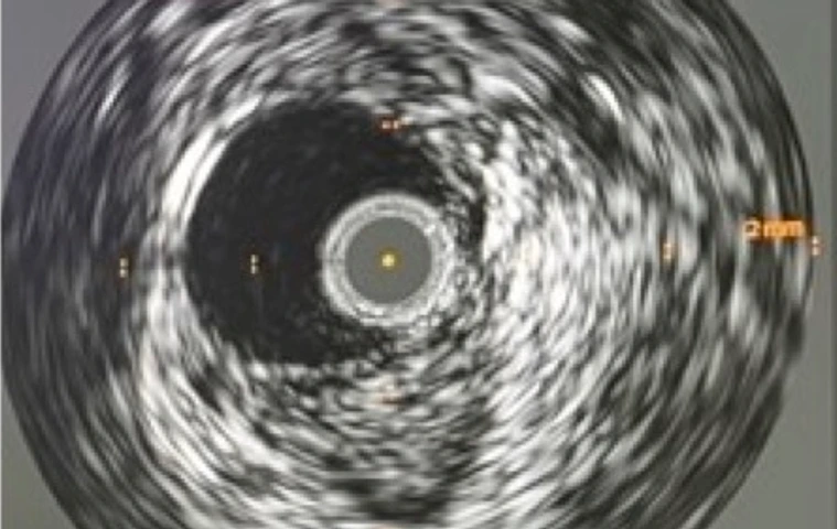 Intravaskulärer Ultraschall