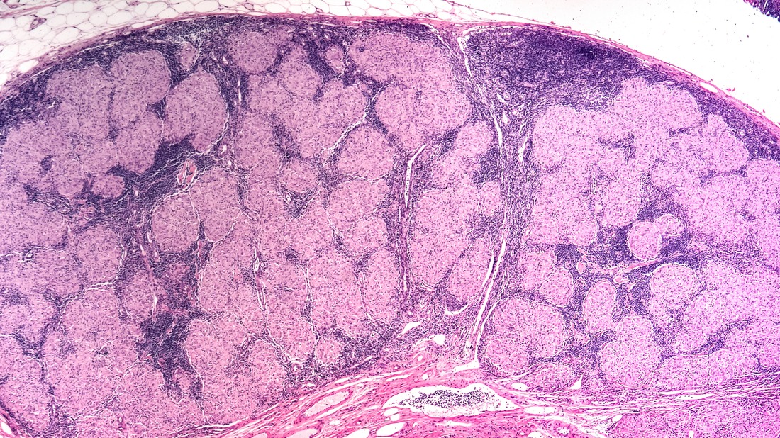 Sarcoidosis Awareness