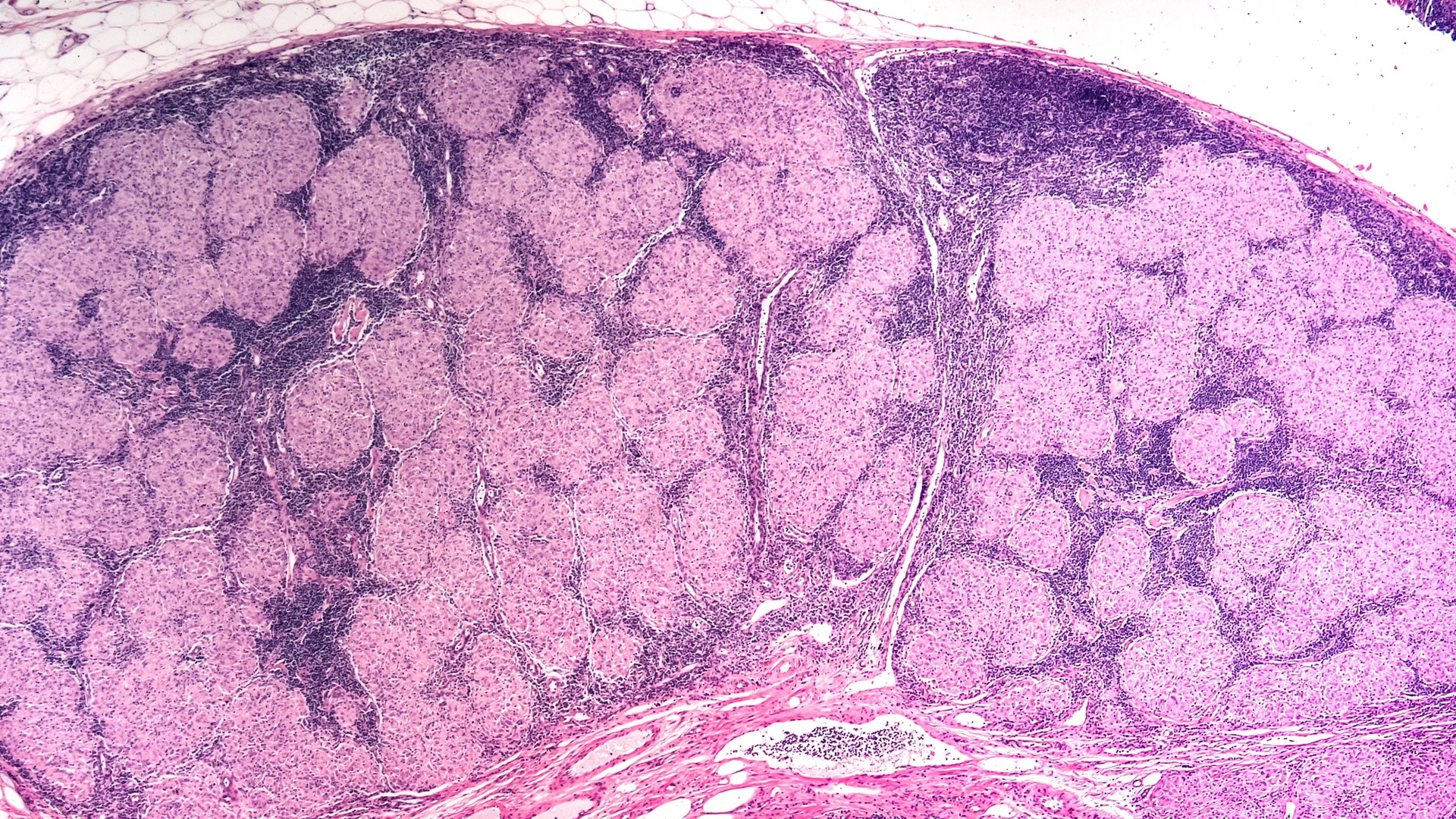 Sarkoidose-Granulome
