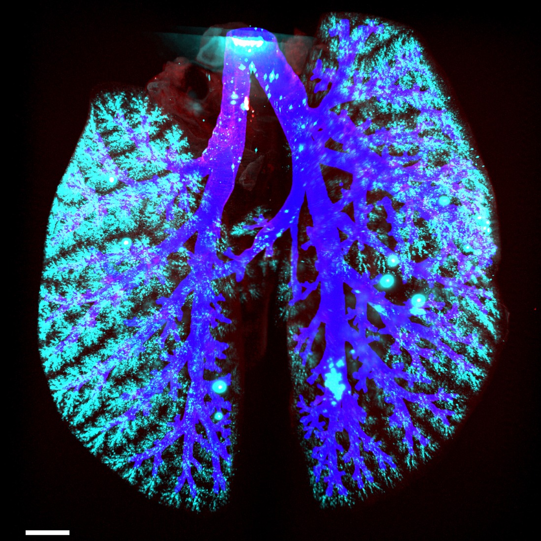 AI-assisted aerosol distribution in lung LHI
