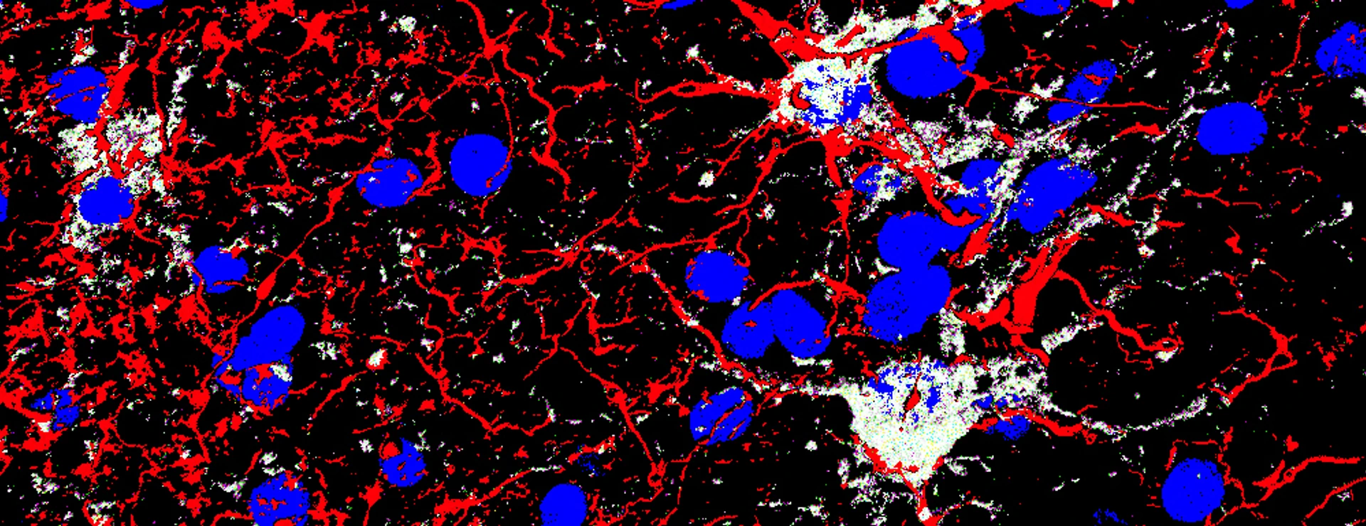 GFAP (red) Gal3 (white) DAPI (blue) gliosis hemorrhage