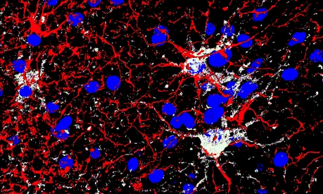 GFAP (red) Gal3 (white) DAPI (blue) gliosis hemorrhage
