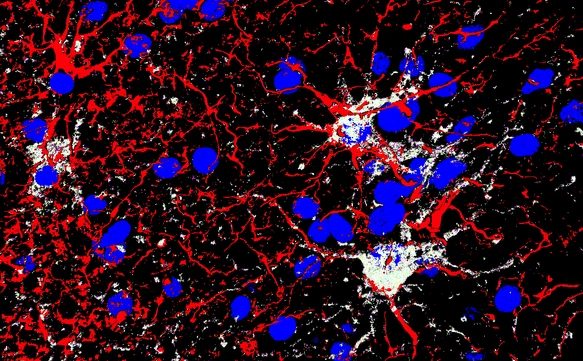GFAP (red) Gal3 (white) DAPI (blue) gliosis hemorrhage