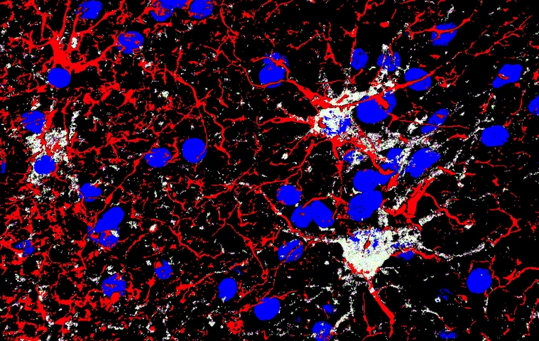 GFAP (red) Gal3 (white) DAPI (blue) gliosis hemorrhage