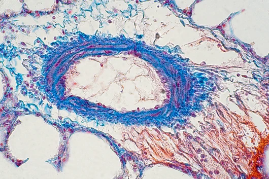 Human lung tissue under microscope view.