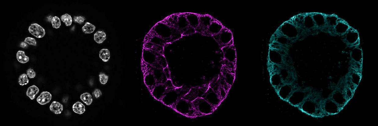 IDR_OC_primarypanreatic_cyst