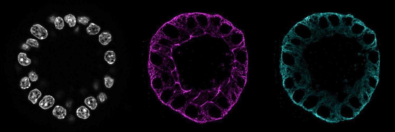 IDR_OC_primarypanreatic_cyst