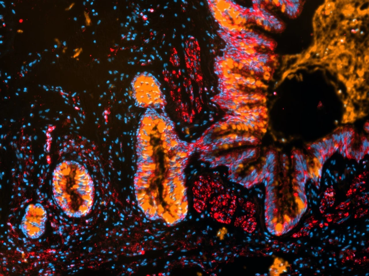 microscops picture of airways of pulmonary fibrosis patients