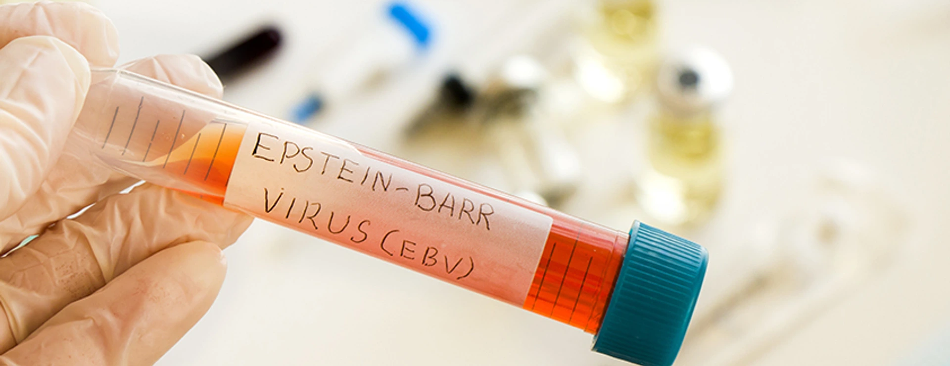 Mononucleosis and Epstein-barr virus blood test sample in lab on the white background