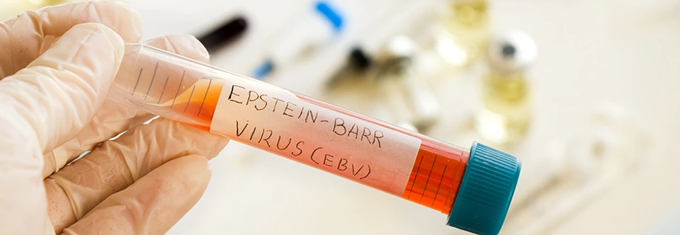 Mononucleosis and Epstein-barr virus blood test sample in lab on the white background