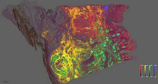 Heterogeneous distribution of four metabolites in cancer tissue