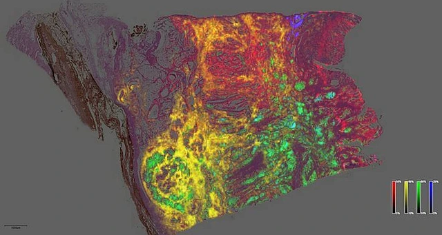 Heterogeneous distribution of four metabolites in cancer tissue
