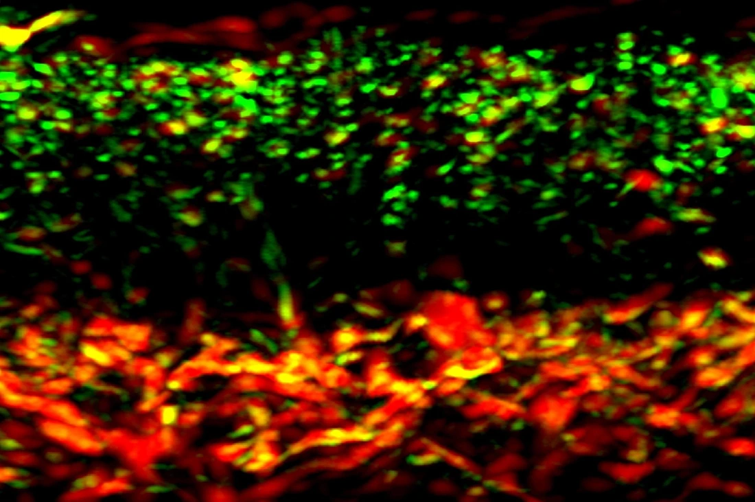 RSOM image of psoriatic skin