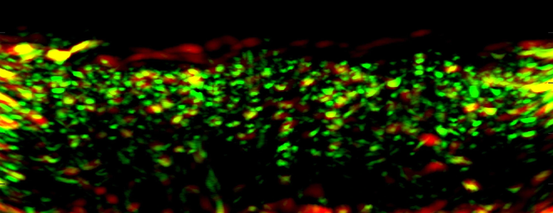 RSOM image of psoriatic skin