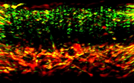 RSOM image of psoriatic skin