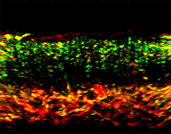 RSOM image of psoriatic skin